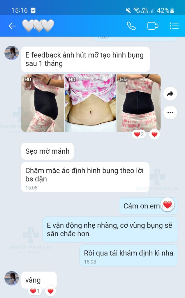 Khách hàng feedback sau 1 tháng hút mỡ tạo hình thành bụng do bác sĩ Bảo Ân thực hiện