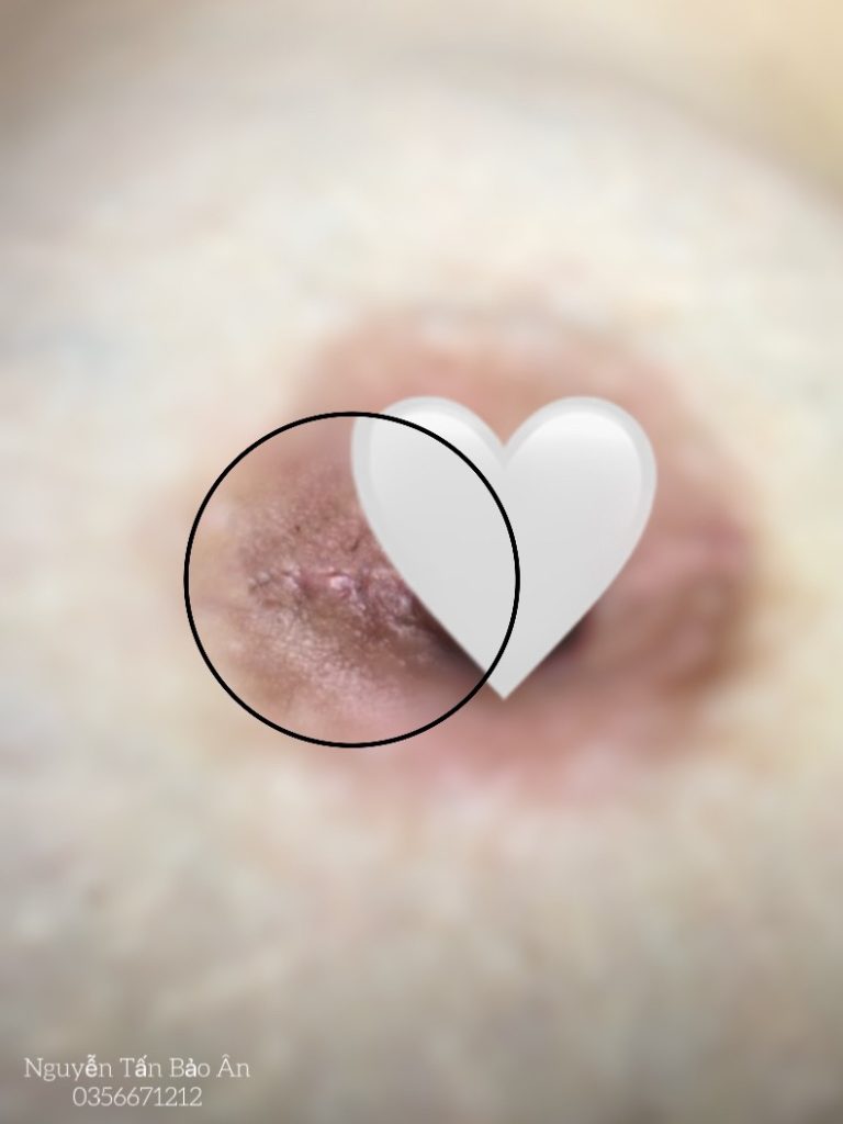 Sẹo nâng ngực đường quầng