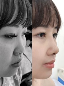 bác sĩ nguyễn tấn bảo ân nâng mũi