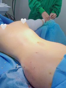 khách hàng hút mỡ bụng